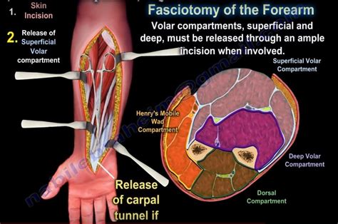 Forearm Compartments Anatomy Nspdd
