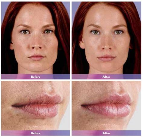 The cost to undercoat a car or truck. Juvederm Before & After Photos, Juvederm Costs & Side Effects