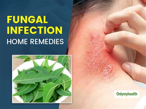 Fungal Skin Infection Bothering You Here Are 5 Home Remedies To Get
