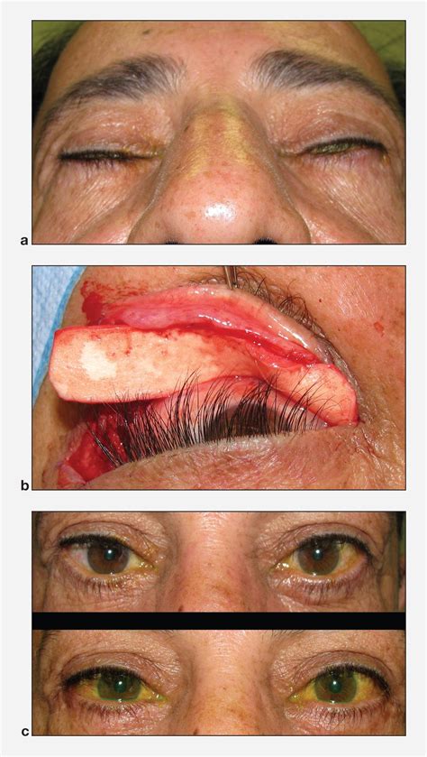 Repair Of Lagophthalmos American Academy Of Ophthalmology