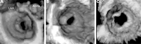 Three dimensional echocardiography for the assessment of mitral valve