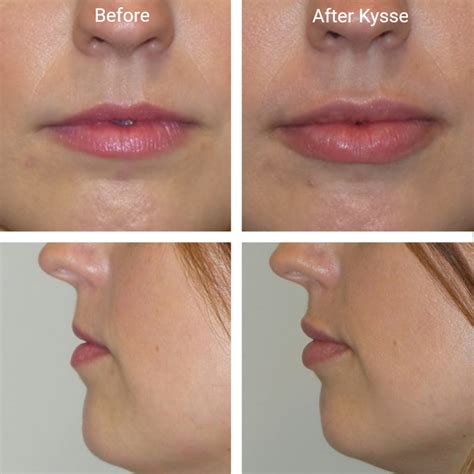 Restylane Lips Before And After Photos