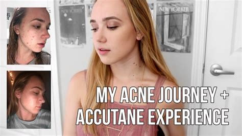 How I Cleared My Acne Accutane Experience Skin Care Journey Youtube