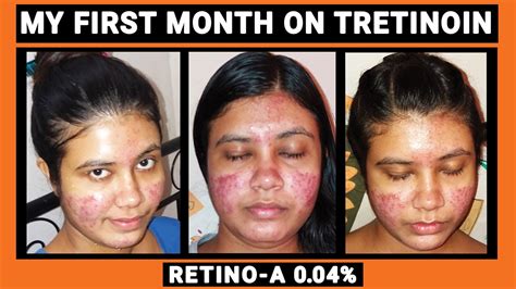 Retin A 1 Month Review Tretinoin With Pictures Cystic Acne And Skin