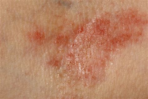 9 Common Rashes Women Complain About Vitamins For Skin Dry Skin