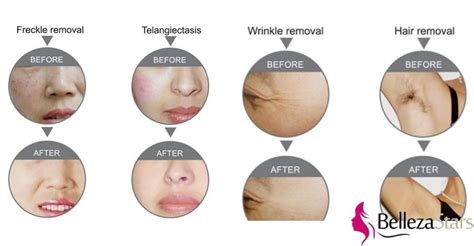 Ipl hair removal reviews for the best ipl machines included. Hair Removal Treatment IPL before and after - Beauty Machine Supplier