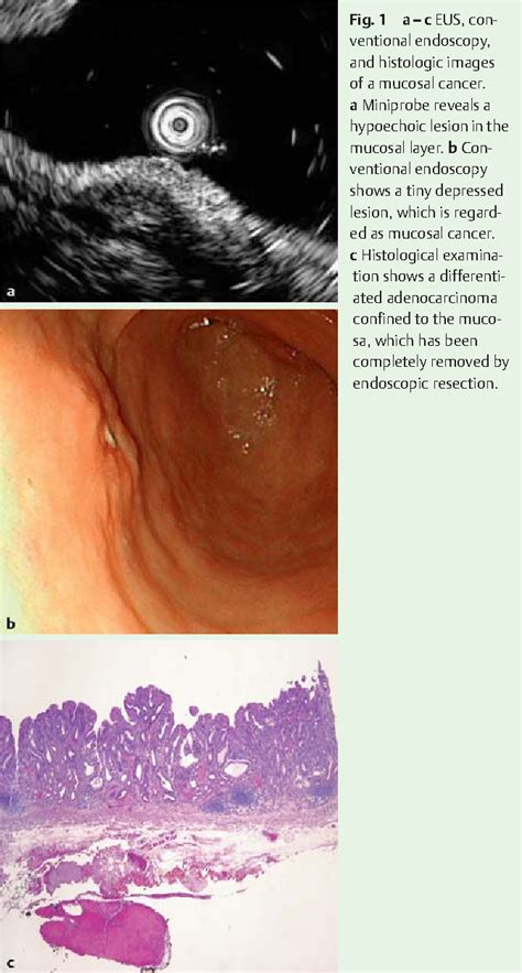 Figure From Comparison Of Endoscopic Ultrasonography And Conventional