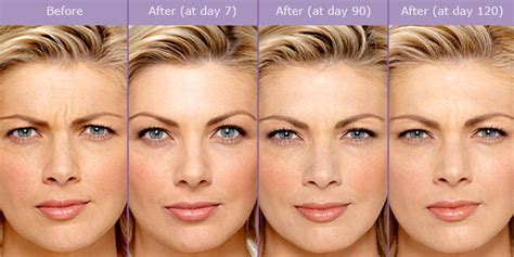 How Long Does Botox Last Before And After Pictures Injections