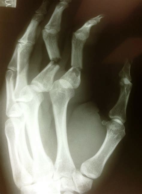 Broken Finger Treatment In Raleigh Nc Raleigh Hand Center Raleigh