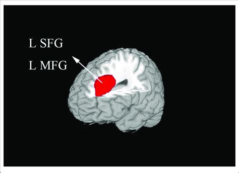 The Areas Of Increased Gray Matter Volumes In Patients With Type 1