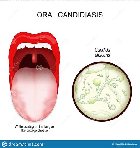 Oral Candidiasis Yeast Infection Ofl Candida Albicans The Mouth