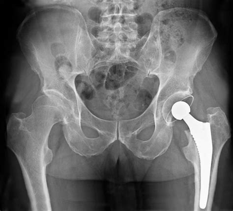 What Are The Different Types Of Hip Replacement Procedures