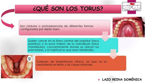 Tórus Mandibular é Grave
