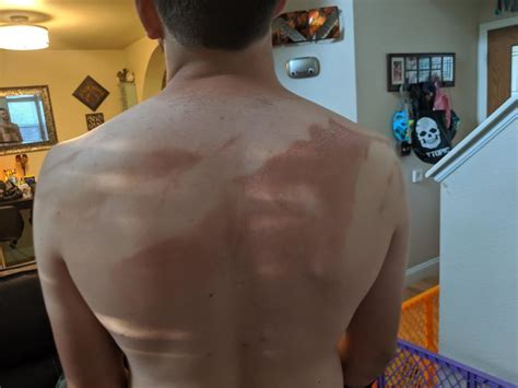 Always Wear Sunscreen 40 People Who Failed To Do It And Ended Up