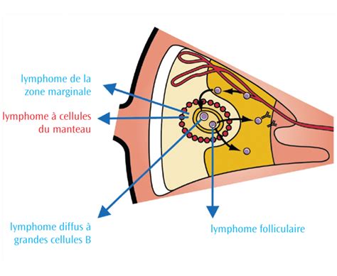 Les Différents Types De Lymphomes Non Hodgkiniens Lymphoma Canada