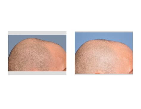 How Successful Is Skull Reduction Surgery Plastic Surgeon Dr