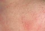 Skin Heat Rash Treatment Pictures