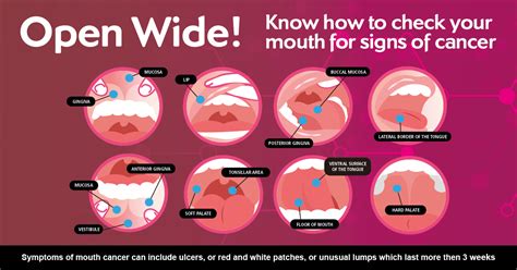 Mouth And Throat Cancers Thamesvalleycanceralliancenhsuk