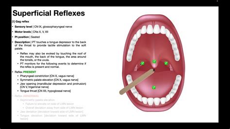 Gag Reflex Procedure Results Interpretation Youtube