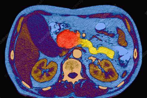 Pancreatic Cancer Coloured CT Scan Stock Image C Science