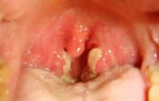 White Spots Tonsils Cancer