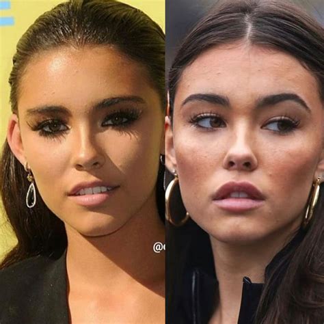 Madison Beer Before And After In 2022 Eyebrow Lift Cheek Fillers