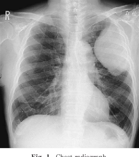 Figure 1 From Localized Malignant Pleural Mesothelioma A Case Report