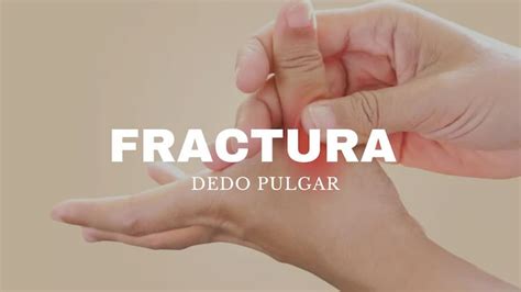 Cómo Identificar Y Tratar Las Fracturas En El Dedo Pulgar Consejos De