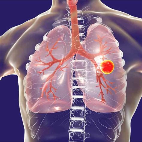 Tuberculosis (tb) is a potentially serious infectious disease that mainly affects the lungs. ¿Qué es la tuberculosis y cómo se trata? - Raincity Grill