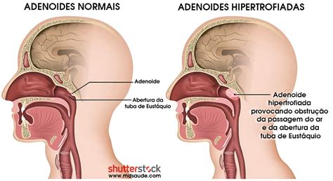 Hipertrofia das adenoides da clínica ao tratamento