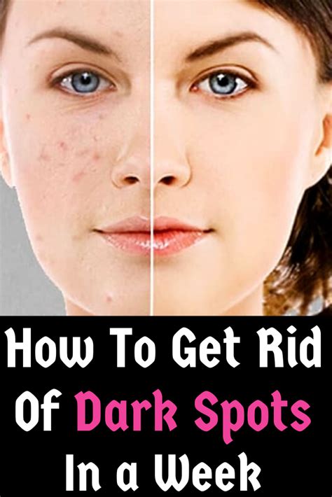 how to get rid of dark spots overnight with home remedies trabeauli dark spots on face dark