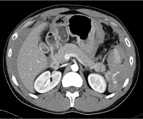 Abdominal Ct Scan Grade Iv Splenic Injury With Contrast