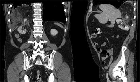 Surgical Management Of Symptomatic Right‐sided Bochdalek Hernias In