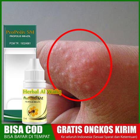 Jual Obat Gatal Berair Di Jari Tangan Dan Kaki Obat Bintik Bening Berair Gatal Bernanah