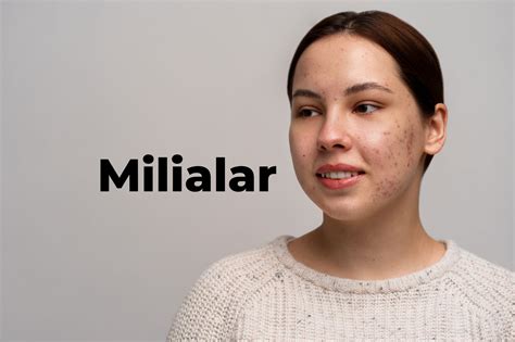 The World Of Milialar Understanding Treating And Preventing Skin