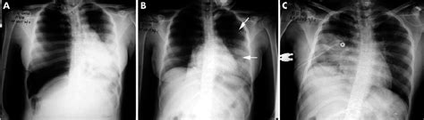 The new england journal of medicine. (A) Right sided tension pneumothorax with mediastinal ...