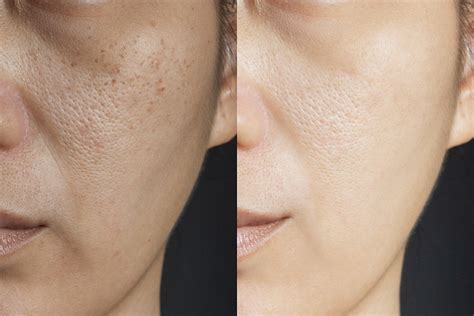 Large Pores Before And After