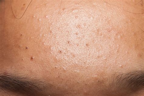 Heres How To Cover Every Type Of Pimple Allure