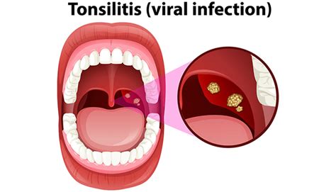 Tonsillitis Symptoms Treatment And Causes Apex Hospitals