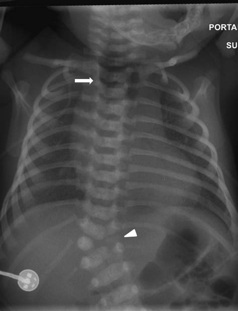 Neonatal And Pediatric Bowel Obstruction Radiology Key