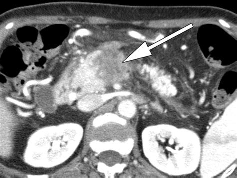 Comprehensive Preoperative Assessment Of Pancreatic Adenocarcinoma With