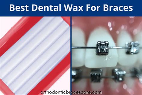 Best Dental Wax For Braces 5 Flavored And 7 Unflavored Orthodontic