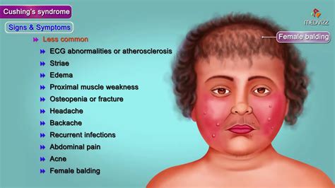 Cushing Syndrome Causes Symptoms Diagnosis Treatment Pathology