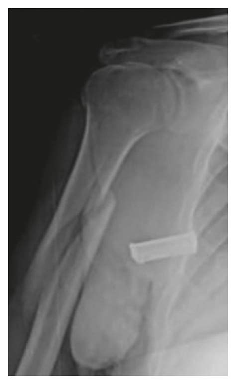 A 41 Year Old Female Patient Had Humeral Diaphyseal Fracture Due To A