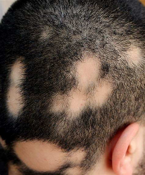 Signs And Symptoms Of Alopecia Areata All You Need To Know