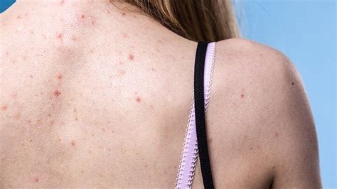 Back Acne Bacne Why Pimples Pop Up And How To Prevent And Get Rid