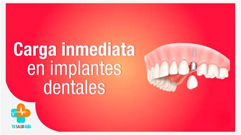 Carga Inmediata En Implantes Dentales Tu Salud Guía Youtube