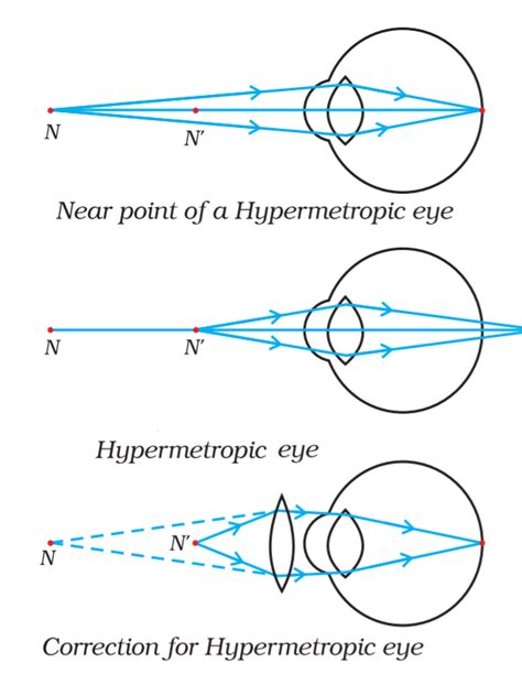 Make A Diagram To Show How Hypermetropia Is Corrected The Near Point