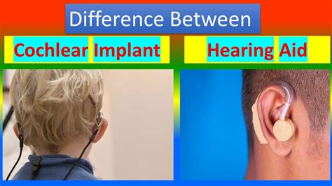 Difference Between Cochlear Implant And Hearing Aid Youtube
