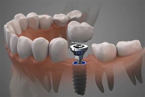 A Brief Look At The Dental Implant Procedure Santa Rosa Ca